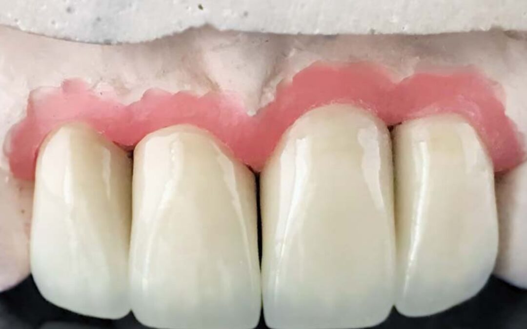 Why Denture Glue Can Cause More Problems Than It Solves