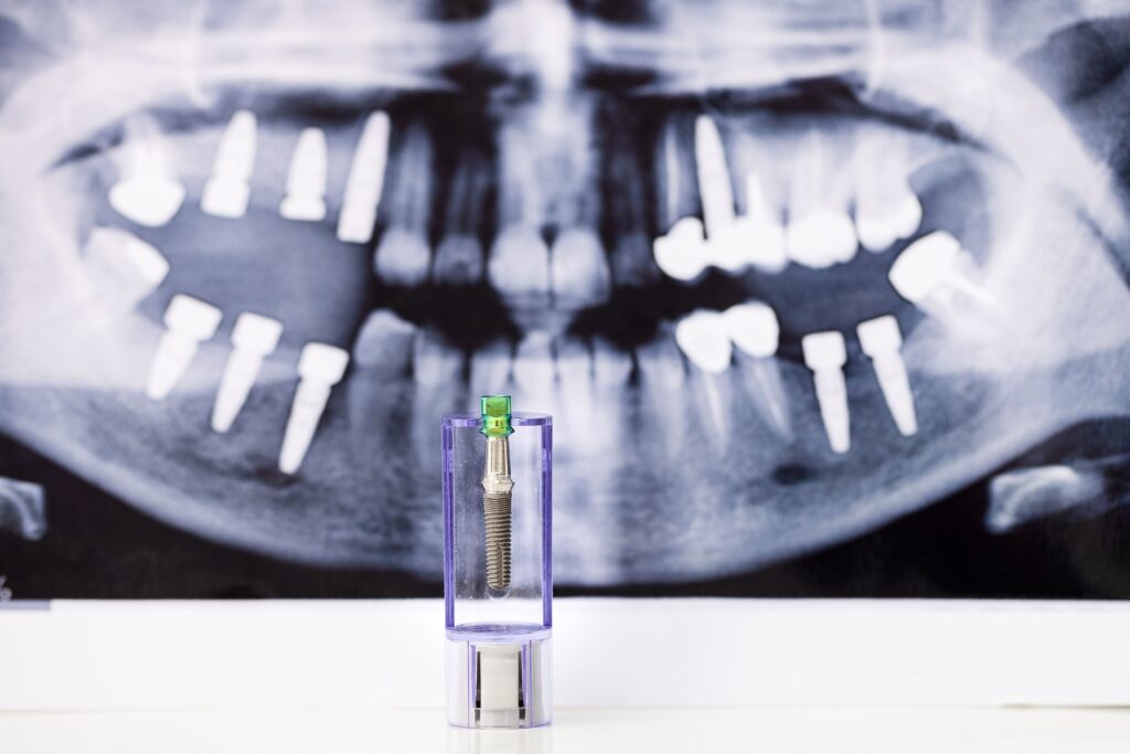 Implant-Supported Dentures in Brisbane